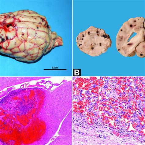 Metastatic Hemangiosarcoma In The Central Nervous System Of Dogs A