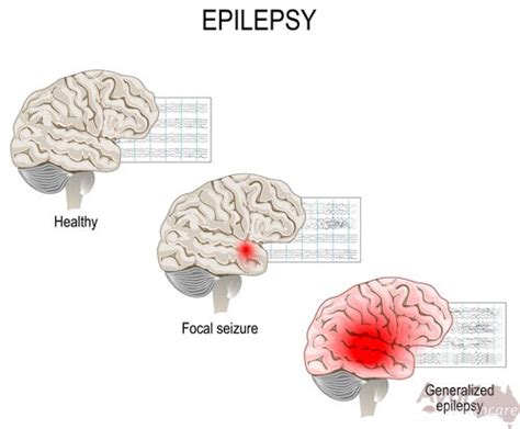 Epilepsy Ayur Healthcare