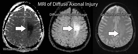 Diffuse Axonal Injury Injury Medical