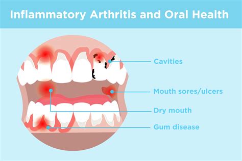 Inflammatory Arthritis And Oral Health Prevention Symptoms Treatment