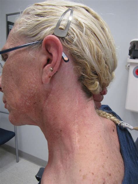 Case Example Posterolateral Neck Dissection Iowa Head And Neck Protocols