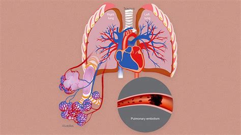 What Is Pulmonary Arterial Hypertension Pah Everyday Health