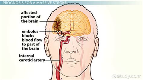 Massive Stroke Recovery Timeline And Prognosis Video And Lesson