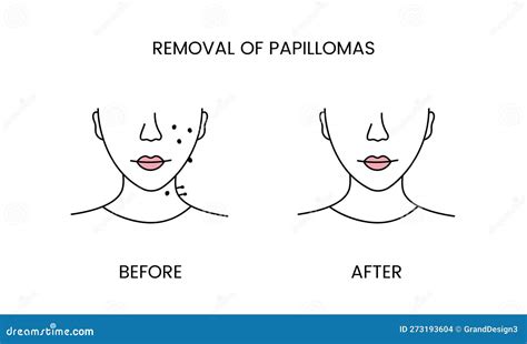 Removal Of Papillomas Laser Cosmetology Before Procedure And After