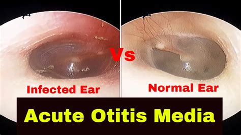 Acute Otitis Media Diagnosis And Treatment Youtube