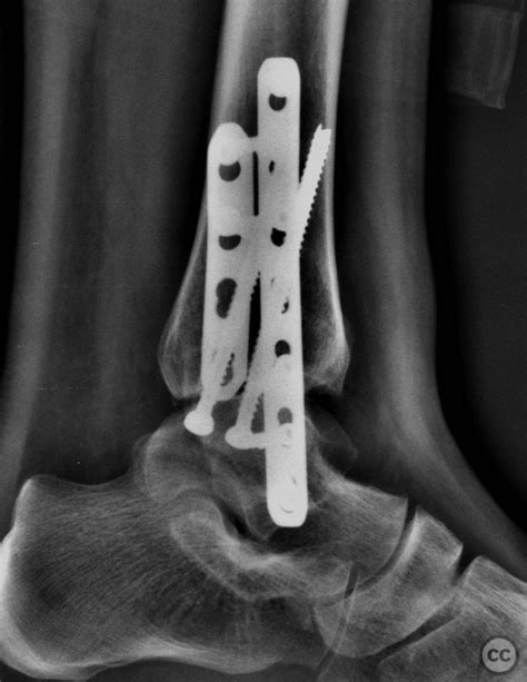 Compound Fracture Dislocation Of Left Ankle