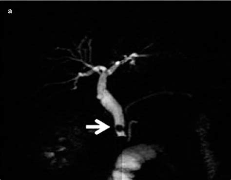 Ab Magnetic Resonance Cholangiopancreatography A And Endoscopic