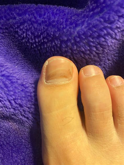 Dark Spots Under Toenail I Am A Little Concerned About These Spots