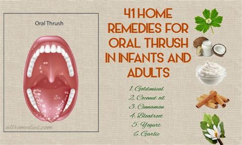 Top 41 Home Remedies For Oral Thrush Causes Symptoms Prevention