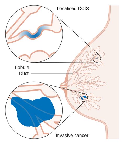 Breast Carcinoma In Situ Lobular Ductal Lcis Dcis Teachmesurgery