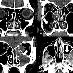 Computed Tomography Findings Of Rhino Orbito Cerebral Mucormycosis And