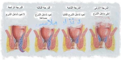 شكل البواسير الخارجية