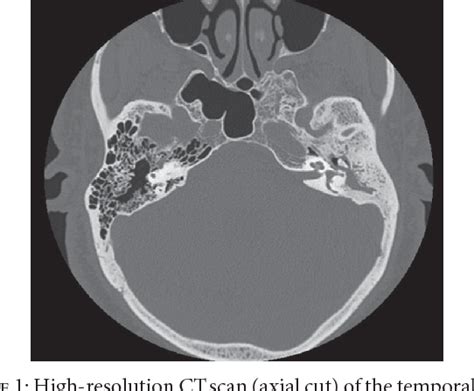 Figure 1 From Non Hodgkins Lymphoma Of The Middle Ear Presenting As