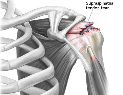 Figure Rotator Cuff Tear StatPearls NCBI Bookshelf