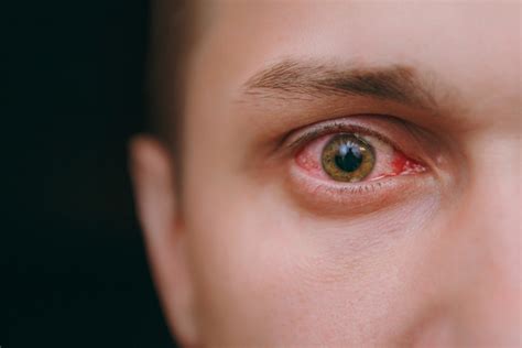 It will take from two to six weeks for symptoms to develop—what is known as a delayed, or type iv, allergic reaction. Is Eye Pain a Symptom of Coronavirus? Google Searches for ...