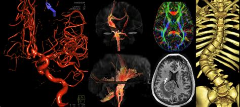 Uc Davis Department Of Radiology Neuroradiology