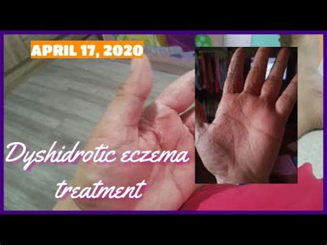 Can i do a free online doctor consultation on practo? DYSHIDROTIC ECZEMA TREATMENT | FREE DERMATOLOGIST ONLINE ...