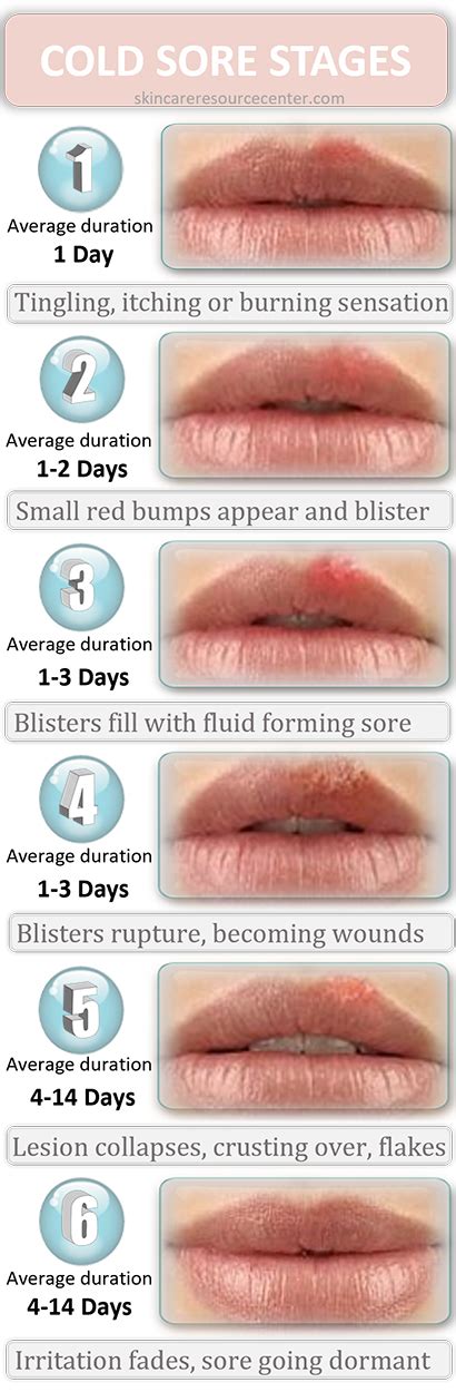 Treating Cold Sores Healing Tips Cold Sore Remedies And Prevention