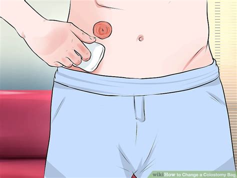 Don't worry, a lot of ostomy bags are washable but most of these are disposable. How to Change a Colostomy Bag: 12 Steps (with Pictures ...