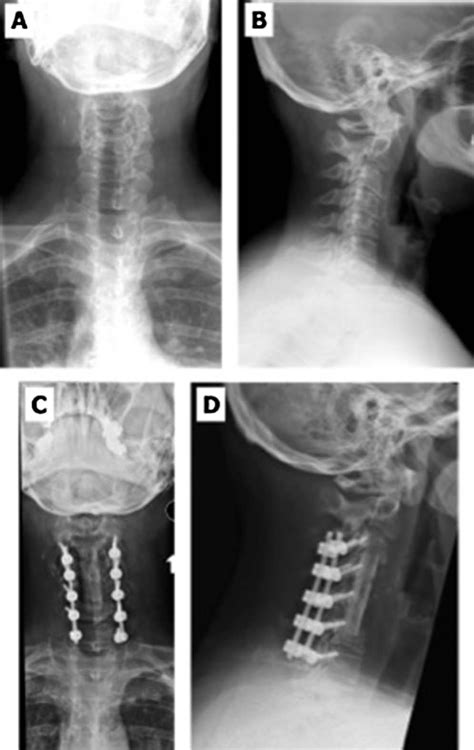 Recurrent Anterior Cervical Wound Abscesses Following Cervical