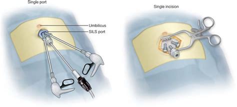 Single Access Laparoscopic Hernia Repairs Abdominal Key