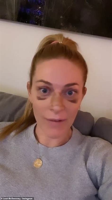 Rhonys Leah Mcsweeney Proudly Reveals Bruises From A Nose Job I Am