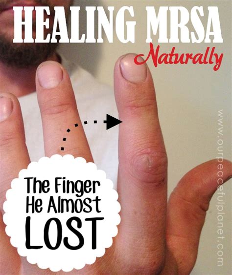Mrsa Staph Infection Healed Naturally Our Peaceful Planet Natural