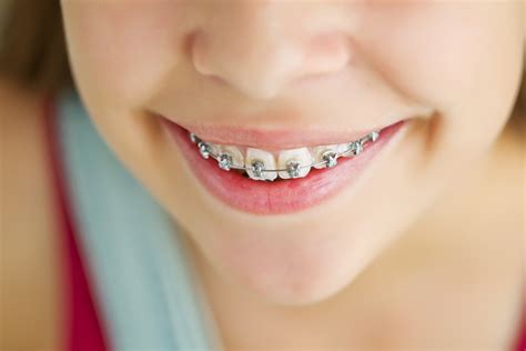 Brace Retainer And Orthodontic Prices In Eastbourne East Sussex