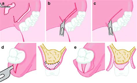 Subepithelial Connective Tissue Sctg Harvesting Techniques