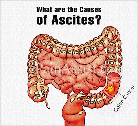 What Is Ascites And Paracentesis