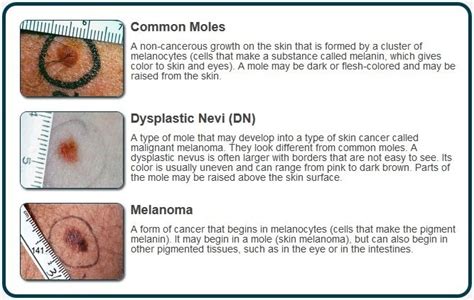How To Tell The Difference Between A Mole And Cancer Cancerwalls