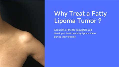 Ppt Lipoma Wand A Latest Modern Lipoma Removal Approach Powerpoint
