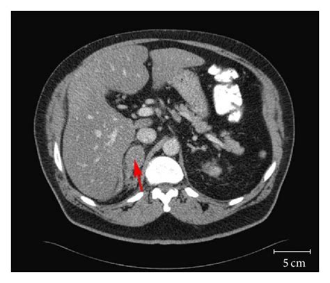 Abdominal Computed Tomography Ct Scan Revealing A 36 × 27 Cm Mass