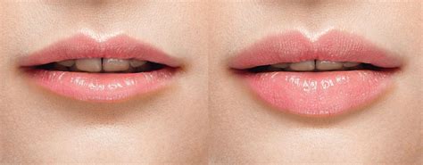 Top 5 Benefits Of Lip Fillers Mymeditravel Knowledge