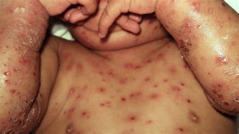 Use some naturally chicken pox vaccine cost malaysia found in many cold fluids and avoid herpes outbreaks. Chicken pox outbreak in Timaru school under control ...