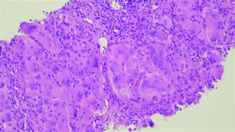Liver Biopsy Giant Cell Hepatitis Large And Multinucleated Hepatocytes