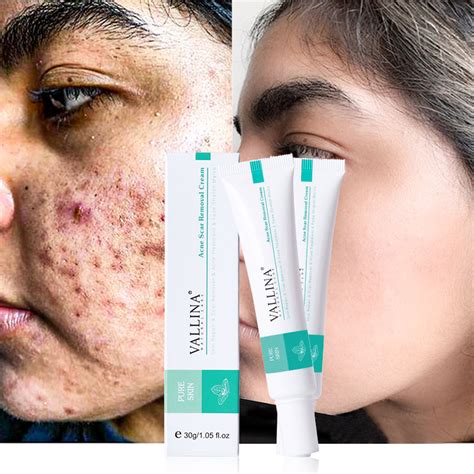 21 Best Acne Scar Treatments 2021 According To Dermatologists Allure