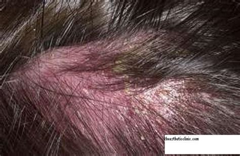 Seborrheic Dermatitis Treatment Scalp Pictures Photos