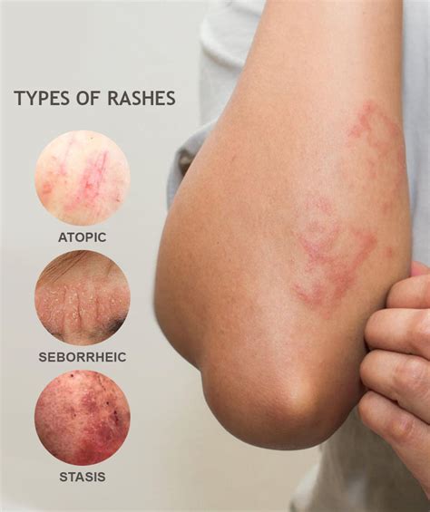 Skin Rash Types And Treatments All You Need To Know Hammer And Nails