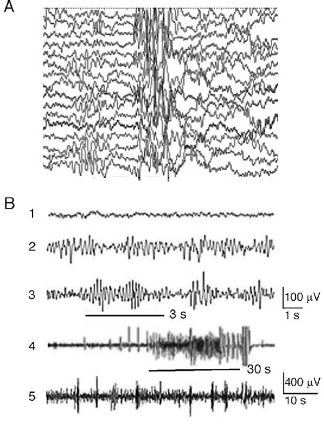 Dravet Syndrome A Interictal Scalp Eeg Recording In A Male Patient Download Scientific