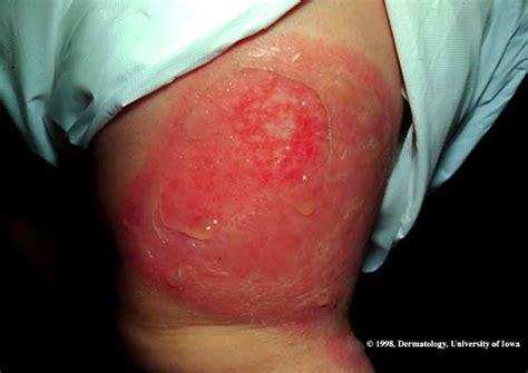 Staphylococcal Scalded Skin Syndrome Department Of