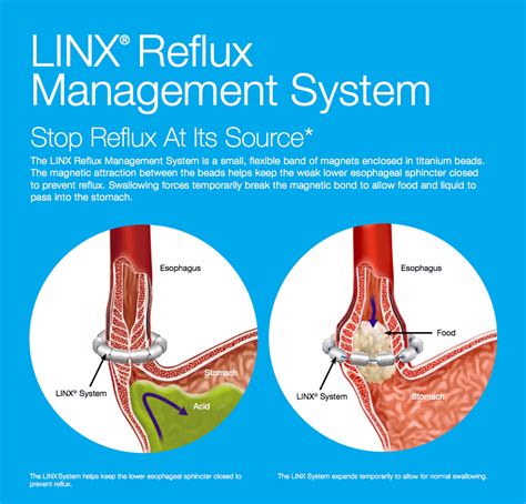 As a nursing student, you must be familiar with gerd and how to care for patients who are experiencing this condition. LINX®: A game-changing treatment for acid reflux and GERD ...