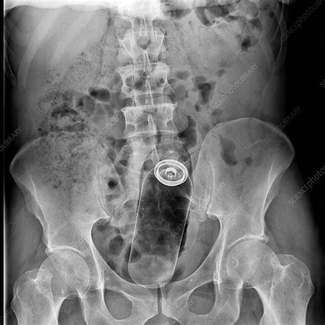 Foreign Body In Rectum X Ray Stock Image C Science Photo