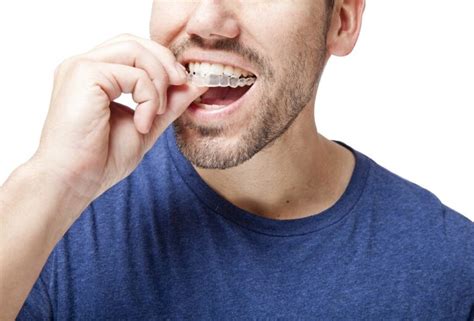 Everything About Invisalign That You Need To Know