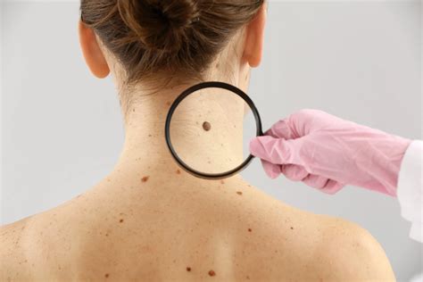 What To Expect At A Full Body Skin Cancer Exam
