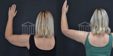 Bodytite Before And After Images Zenith Cosmetic Clinic