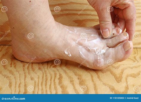 a woman puts some cream on her foot stock image image of inflammation gout 118105803
