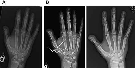 Current Management Of Metacarpal Fractures Hand Clinics
