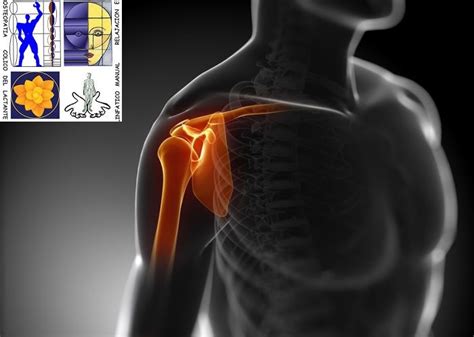 IMPINGEMENT HOMBRO SINDROME SUBACROMIAL Tus Terapias