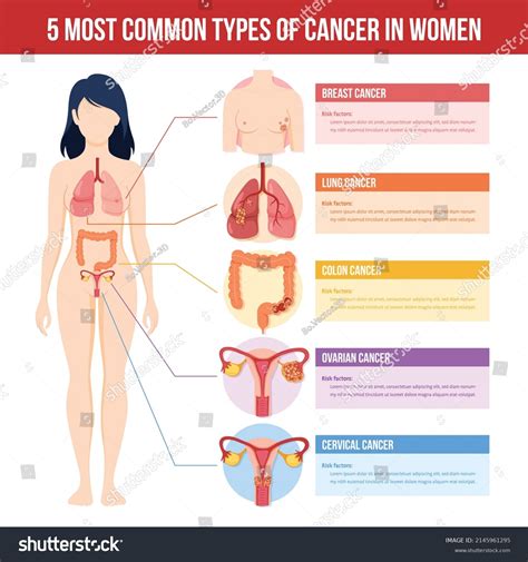 Infographic Most Common Types Cancer Stock Vector Royalty Free